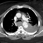 Acute traumatic aortic injury confirmed on the subsequent CT with extensive surrounding hemorrhage and adjacent left hemothorax.