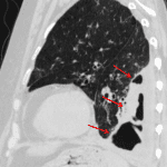 Subsequent CT shows a multiseptated empyema with marked peripheral soft tissue thickening (red arrows).