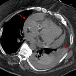 Large pericardial effusion confirmed on a subsequent CT (red arrows).