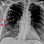 Irregular thin line along the lateral right hemithorax (red arrows) concerning for pneumothorax.