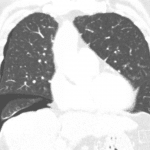 Follow CT shows a multiloculated right pneumothorax.