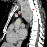 Large thyroid goiter extending inferiorly as a posterior mediastinal mass (red arrows) with mass effect on the trachea (yellow arrow).