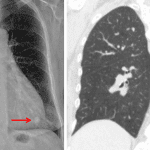 Left lower lobe pulmonary nodule shown on the PA chest radiograph and subsequent CT (red arrows).