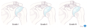 Comparison of grades I-III acromioclavicular separation.