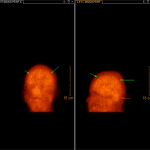 Static images show preserved cerebral (green arrows) and cerebellar (pink arrow) activity.