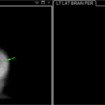 Preserved radiotracer activity in the bilateral cerebral cortex (green arrows) and cerebellum (purple arrow).