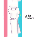 Types of distal radial fractures.