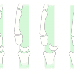 Greater arc carpal dislocations in order of severity from left to right. Far left: normal. Left center: perilunate dislocation. Right center: midcarpal dislocation. Far right: lunate dislocation.