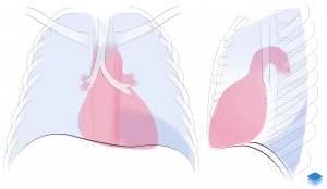 Left lower lobe collapse.
