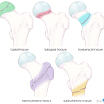 Proximal femoral fracture types.