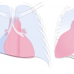 Right lower lobe collapse.