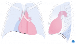 Right lower lobe collapse.