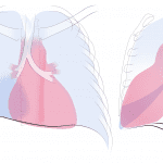 Right middle lobe collapse.