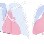 Right upper lobe collapse. Illustration by Valerie George, MD