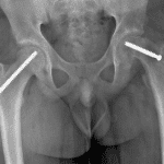 Postoperative radiograph in this patient after bilateral pinning.
