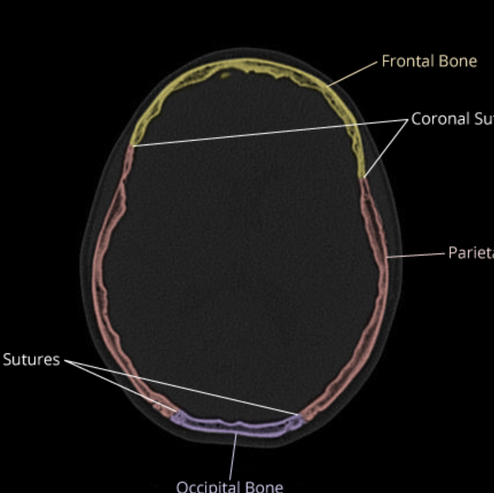 CaseStacks.com - Calvarial Anatomy on CT on Head CT