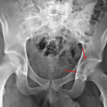 Acute mildly comminuted transverse fracture of the left acetabulum with a fracture component likely extending into the posterior wall (red arrows).