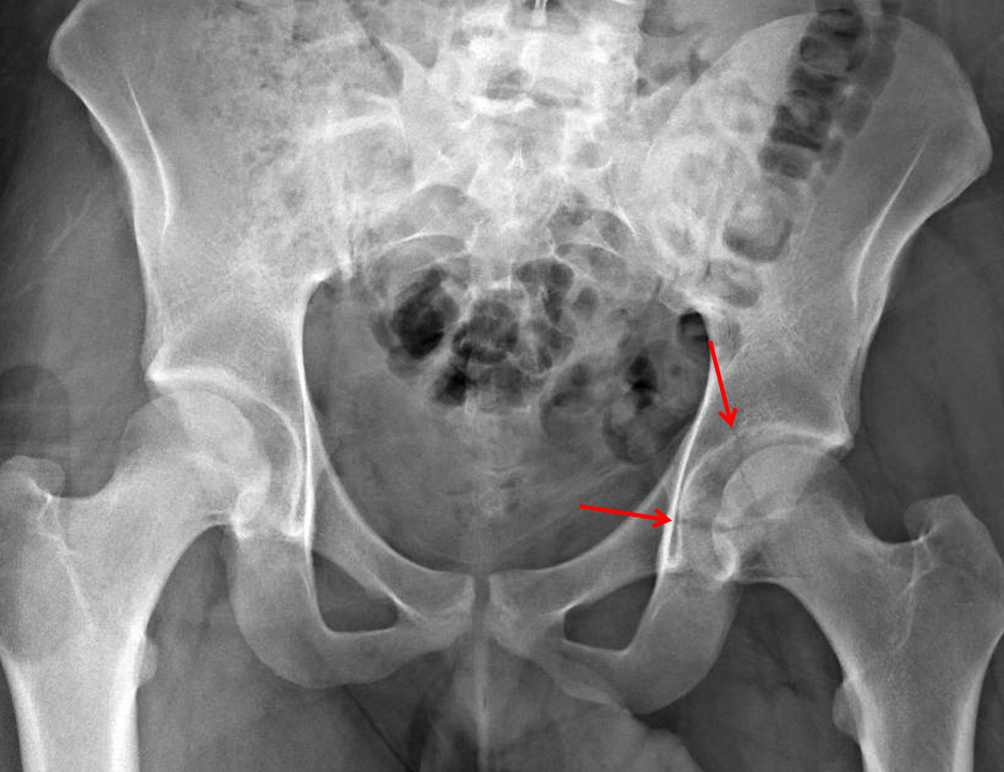 Pelvic Rim Fracture