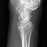 Acute minimally displaced fracture of the dorsal distal radius (red arrow).