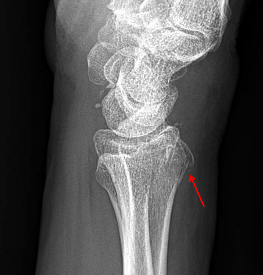 Distal Radial Fractures X Ray