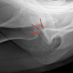 Acute Hill-Sachs impaction fracture along the posterolateral humeral head (red arrows).