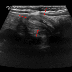 Longitudinal view of an ileocolic intussusception in this patient (red arrows).