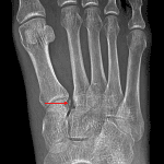Small avulsion fracture from the medial aspect of the base of the second metatarsal (red arrow) consistent with Lisfranc injury.