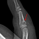 Acute nondisplaced Salter II fracture through the dorsal aspect of the fifth middle phalangeal base (red arrow).