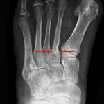 Transverse sclerotic band in the proximal second metatarsal consistent with stress fracture (red arrows).