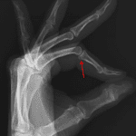 Acute nondisplaced fracture involving the volar base of the second middle phalanx (red arrow).