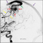 Diagnostic catheter angiogram in this patient. Left ICA injection shows the AVM nidus (red arrows) with feeding arteries from MCA branches (yellow arrows), cortical venous drainage (green arrow), and early filling of the superior sagittal sinus (purple arrows).