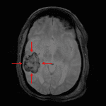 Posterior right temporal parenchymal hematoma nicely delineated on this gradient sequence (red arrows).