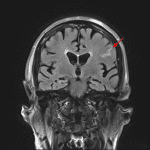 Acute sulcal subarachnoid hemorrhage in the left inferior frontal sulcus (red arrow) on this FLAIR sequence.