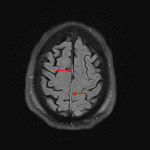 Thin subdural hematoma along the interhemispheric falx (red arrows) on this FLAIR sequence.