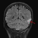 Small area of FLAIR signal hyperintensity in the left middle temporal gyrus (red arrow).