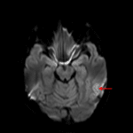 Faint cortical diffusion signal hyperintensity (red arrow).
