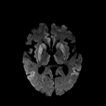 Symmetric restricted diffusion involving the bilateral caudate nuclei, putamina, pulvinar nuclei of the thalami, and cerebral cortex in this patient with Creutzfeldt-Jakob disease.