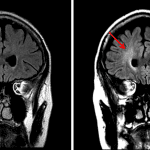 Initial coronal FLAIR sequence from this patient (left) compared to a followup FLAIR sequence one month later (right) showing increased periventricular FLAIR signal hyperintensity (red arrows), consistent with delayed onset leukoencephalopathy.