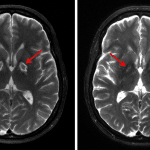 Initial T2-weighted image from this patient (left) compared with a followup T2-weighted sequence obtained one month later showing improvement in T2 signal hyperintensity in the globi pallidi (red arrows).