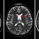 Pulsation artifact on the FLAIR sequence creating an intraventricular pseudolesion without correlate on other sequences (red arrows).