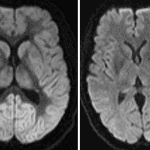 Observe the stark gray-white differentiation on the diffusion sequence in this patient (image on the left) compared to a normal comparison (image on the right). Certainly the appearance of gray and white matter on diffusion will vary based on technique and by scanner, but stark gray-white differentiation like this should prompt further search for evidence of a global abnormality.