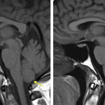 Flattened, expanded sella (red arrow) and low-lying cerebellar tonsil (yellow arrow) in this patient with idiopathic intracranial hypertension. Normal comparison on the right.