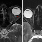 Flattening of the posterior sclera bilaterally (red arrows) in this patient with idiopathic intracranial hypertension. Normal comparison on the right.