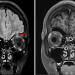 Left orbital roof mass with intracranial and intraorbital extension, as shown on the FLAIR image to the left (red arrow), with ill-defined enhancement in the left orbital roof (yellow arrow) and enhancing soft tissue in the superolateral extraconal left orbit (blue arrow) on the postcontrast image to the right.