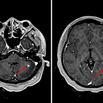 Examples of incomplete ring enhancement in this patient (red arrows).