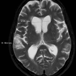 The Evans index is calculated by dividing the maximal axial width of the frontal horns of the lateral ventricles (A) by the maximal inner table - inner table diameter of the skull at the same level (B), which should normally be < 0.3. In this case the Evans index is 0.35.