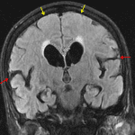 The callosal angle is measured between the inner margins of the lateral ventricles on coronal images at the level of the posterior commissure, and should normally be >100 degrees (it is 68 degrees in this case). Also note the disproportionate enlargement of the sylvian fissures (red arrows) and relative sulcal crowding at the vertex (yellow arrows).