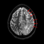 PML: Asymmetric T2 hyperintensity in the left frontoparietal white matter involving the subcortical U fibers (red arrows), which provides a stark signal contrast with the adjacent cortex.