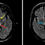 Wernicke encephalopathy: abnormal FLAIR signal hyperintensity in the periaqueductal gray matter of the midbrain (red arrow), involving the hypothalamus (yellow arrows), and involving the bilateral medial thalami (blue arrows).