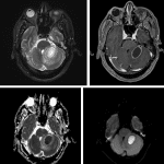 Classic MR appearance of a pyogenic abscess with central T2 hyperintensity and a rim of T2 hypointensity (top left image), peripheral enhancement (top right image), and central restricted diffusion as shown on the ADC map (bottom left image) and diffusion (bottom right image).